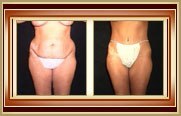 before and after tummytuck photo