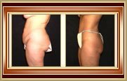 before and after tummytuck photo