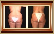 before and after tummytuck photo