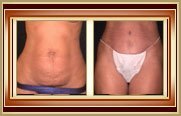 before and after tummytuck photo