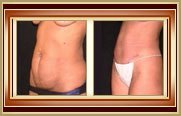 before and after tummytuck photo