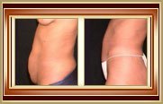 before and after tummytuck photo