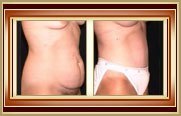 before and after tummytuck photo