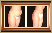 before and after tummytuck photo
