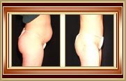 before and after tummytuck photo