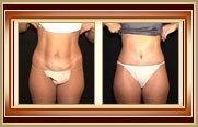 before and after tummytuck photo