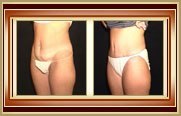 before and after tummytuck photo