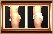 before and after tummytuck photo