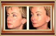 browlift before and after photos