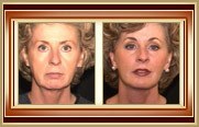 facelift