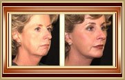 before and after facelift photo