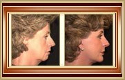 before and after facelift photo