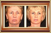 before and after facelift photo