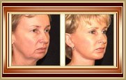before and after facelift photo