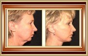 before and after facelift photo