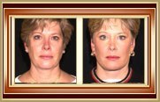 before and after facelift photo