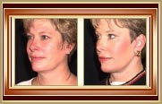 before and after facelift photo