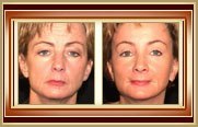 before and after facelift photo