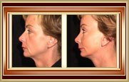 before and after facelift photo