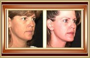 before and after facelift photo
