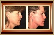 before and after facelift photo