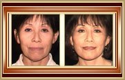 before and after facelift photo