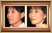 before and after facelift photo