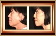 before and after facelift photo