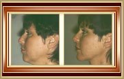 before and after facelift photo