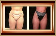 before and after liposuction photo