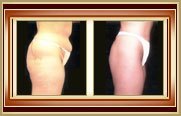 before and after liposuction photo