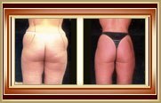 before and after liposuction photo