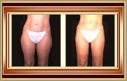 before and after liposuction photo