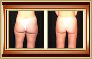 before and after liposuction photo