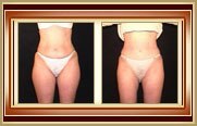 before and after liposuction photo