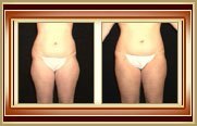 before and after liposuction photo
