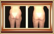before and after liposuction photo