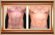 before and after liposuction photo