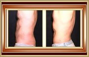 before and after liposuction photo