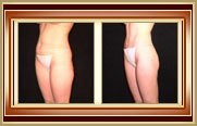 before and after liposuction photo