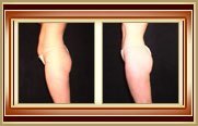 before and after liposuction photo