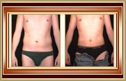 before and after liposuction photo