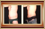 before and after liposuction photo