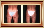 before and after liposuction photo