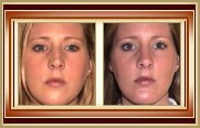 Rhinoplasty