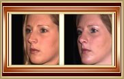 Rhinoplasty before and after photo