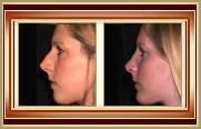 Rhinoplasty before and after photo