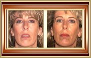 Rhinoplasty before and after photo