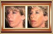 Rhinoplasty before and after photo
