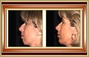 Rhinoplasty before and after photo